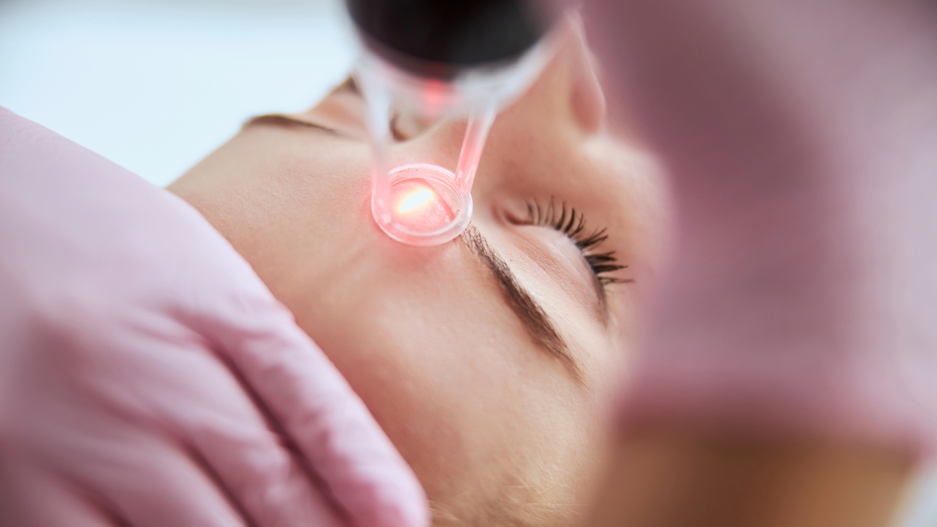 Sublative Radiofrequency Skin Resurfacing